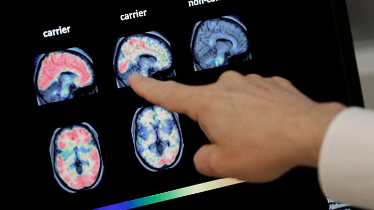 Le vaccin expérimental contre la maladie d'Alzheimer développé par AC Imune est en phase de test. (archive)