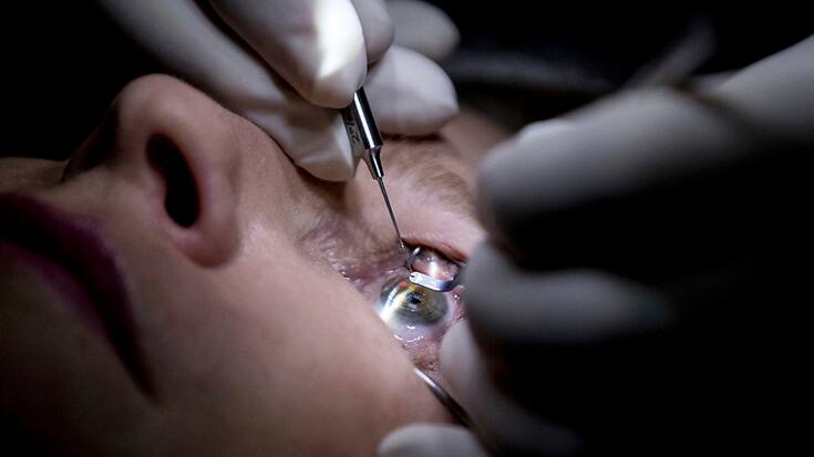 Le béhémoth ophtalmique genevo-texan se renforce ainsi dans la chirurgie de la cataracte. (archive)