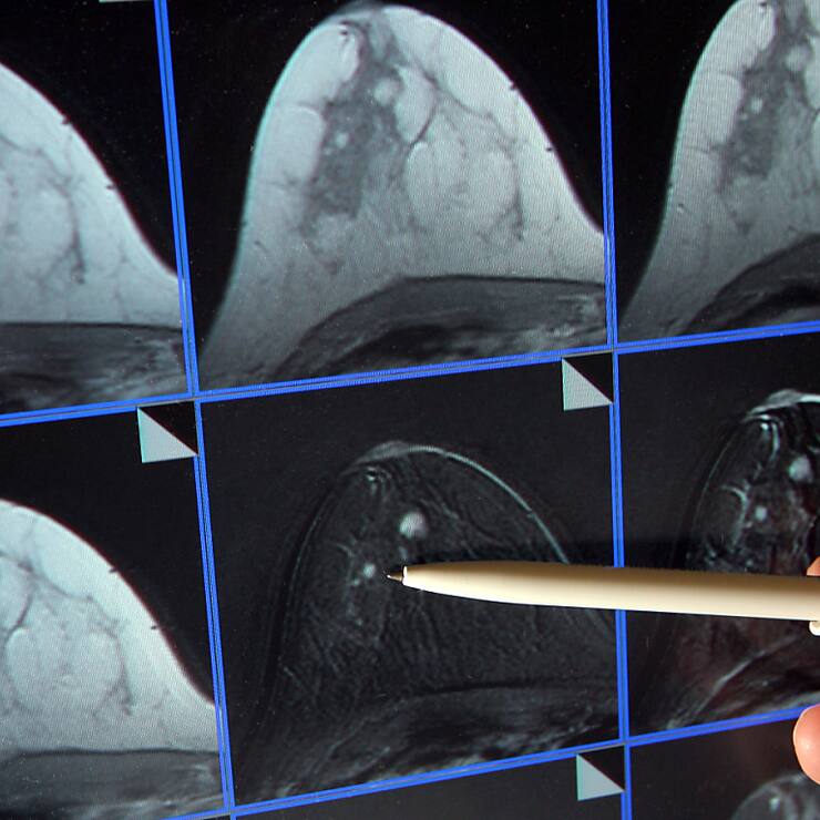 Le cancer du sein occupe déjà une position importante dans la franchise oncologique du géant pharmaceutique rhénan. (archive)