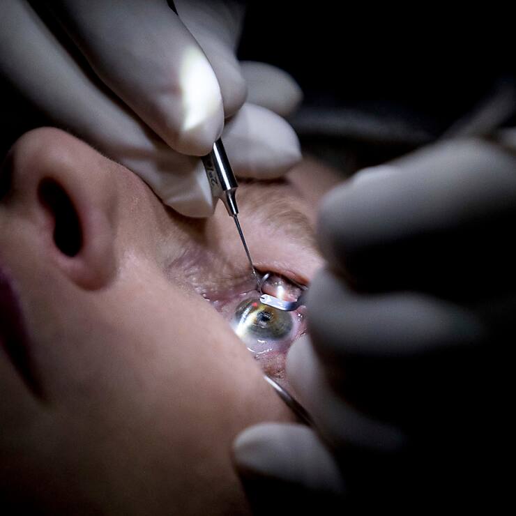 Le béhémoth ophtalmique genevo-texan se renforce ainsi dans la chirurgie de la cataracte. (archive)